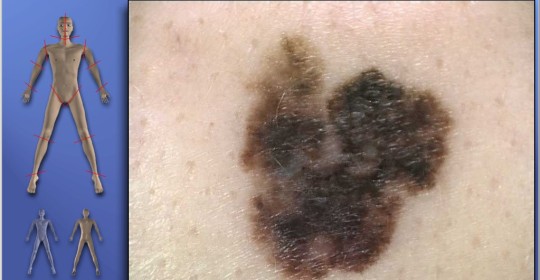 Vyšetření znamének digitálním dermatoskopem